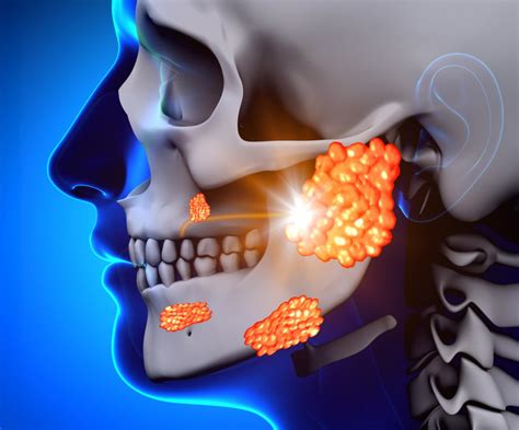 Mumps: Symptoms, causes, and treatment