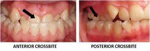 Dental Health….CROSSBITE – Kaieteur News