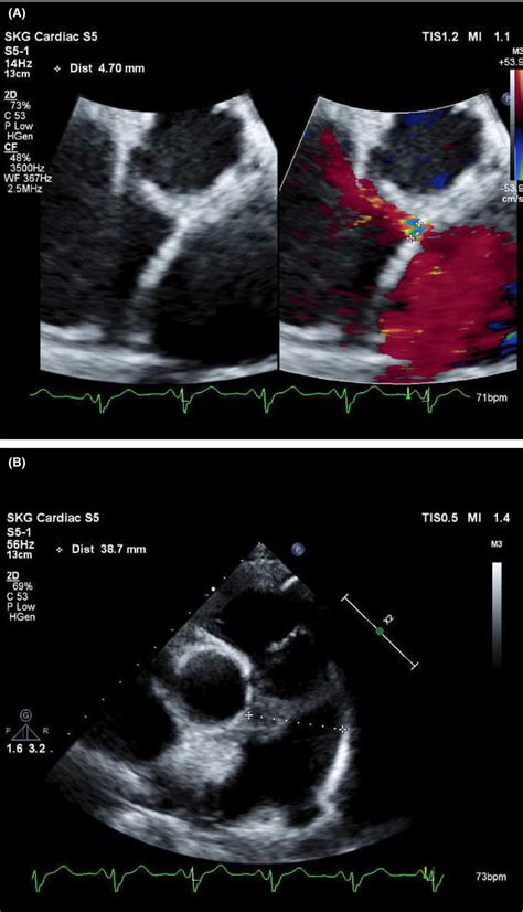 (A, B) Echocardiogram revealed atrial septal defect and pulmonary ...