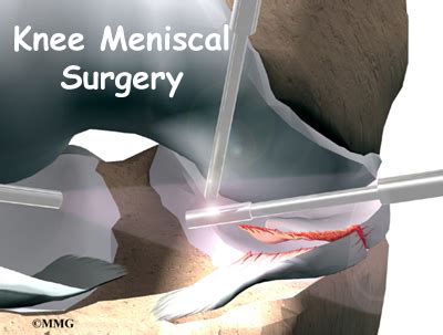 Meniscal Surgery | eOrthopod.com