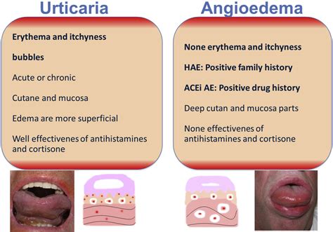 The Angiotensin-Converting-Enzyme-Induced Angioedema - Immunology and ...