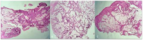 Histological analysis: Adenocarcinoma with a mucinous pattern. (A, B ...