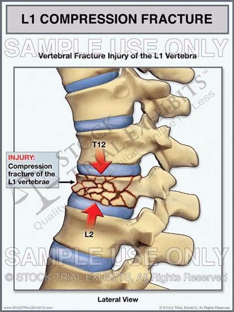 Pin on FRACTURES