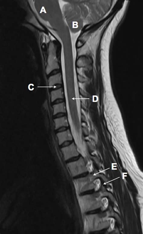 Sagittal T2 weighted magnetic resonance image of the cervical spine ...