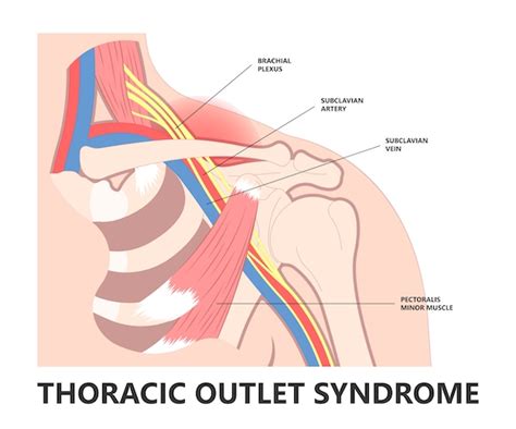 Thoracic Outlet Syndrome | The Surgical Clinic