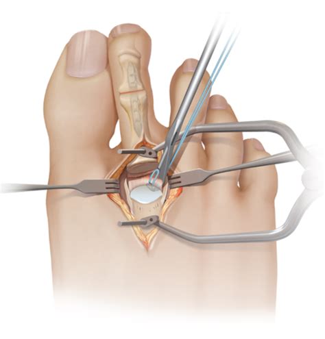 Arthrex - Michael Coughlin, MD - Plantar Plate Repair Surgical Tips and ...