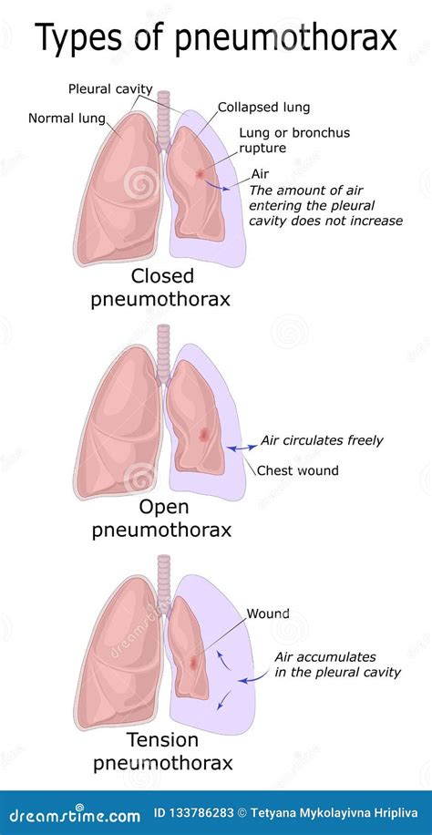 Types of Pneumothorax stock vector. Illustration of health - 133786283