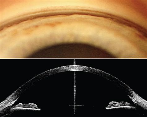 Diagnosing Angle Closure: Gonioscopy vs. OCT