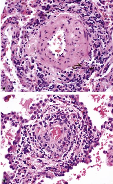 Vasculitis Pulmonar