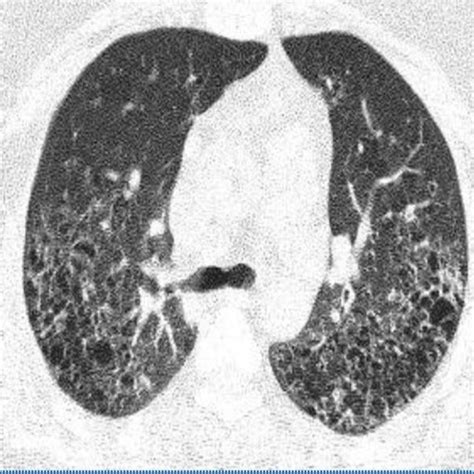 PET-scan for differential diagnosis of lymphoma reveals increased ...