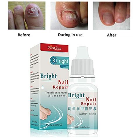 Buy Yiwa Nail Fungus Cream Onychomycosis Paronychia Anti Fungal Nail ...