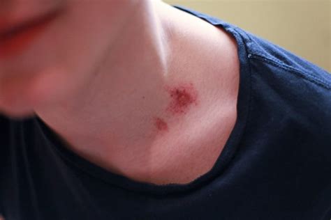 How to Get Rid of a Hickey – Tested Remedies : Online Health Media