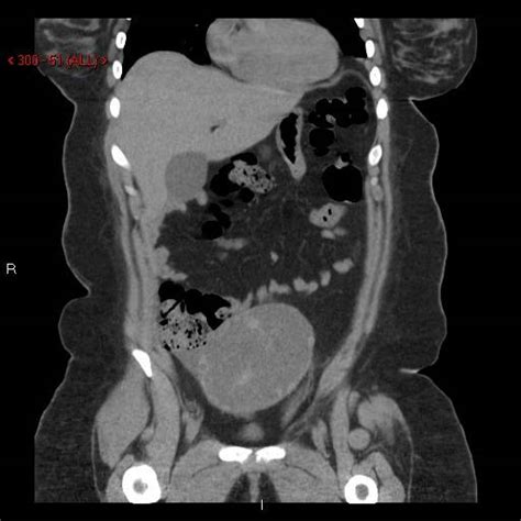 Why Ct Scan Abdomen Pelvis