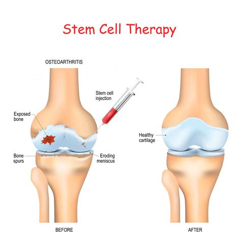 Is Stem Cell Therapy for Arthritis Safe and Effective?