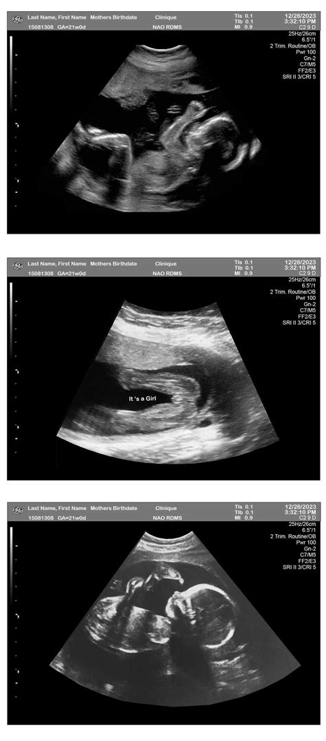 Ultrasound Quintuplets