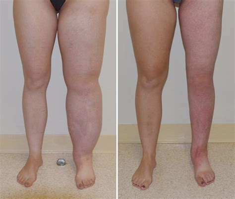 Lipedema vs. Lymphedema | Dr. Jay Granzow, MD