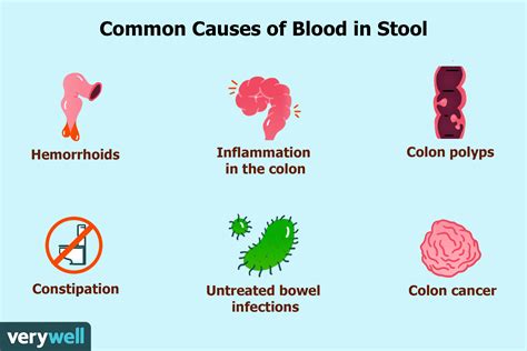 What Causes Bloody Mucus Stools | Images and Photos finder