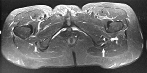 Axial T2-weighted magnetic resonance image at the level of the ischial ...