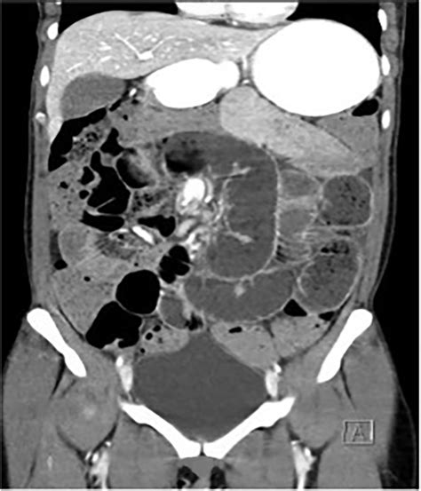 Chronic Intestinal Pseudo-Obstruction Due to Incidentally Fo... : ACG ...