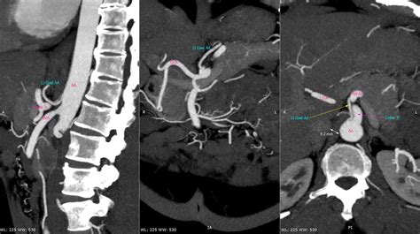 Left gastric artery arising directly from abdominal aorta | Image ...