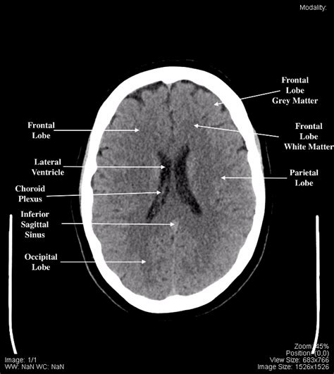 Ct Scan Brain Anatomy Ct Scan Anatomy Of Brain Anatomy Drawing | The ...