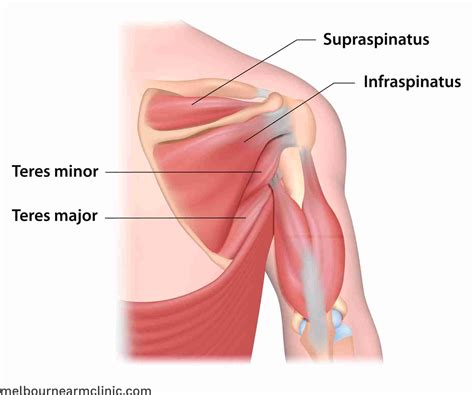 Supraspinatus Tear Causes & Treatment - Melbourne Arm Clinic