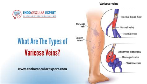 What Are The Types of Varicose Veins? | Endovascularexpert