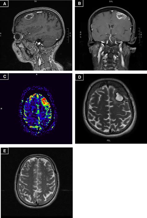 ntracranial capillary hemangioma with avid peripheral enhancement. (A ...