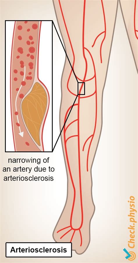 Intermittent claudication | Physio Check