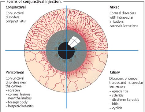 Forms of conjunctival injection انواع احتقانات الملتحمة | حكيم ...