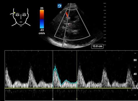 Trans-cranial Doppler - Alberta Sono