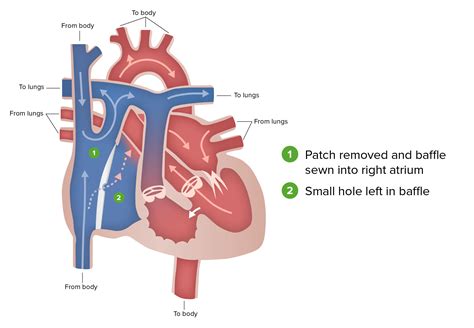 Hypoplastic Left Heart Syndrome (HLHS) | Concise Medical Knowledge