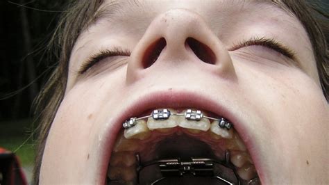 The History of Braces: An Object Lesson - The Atlantic