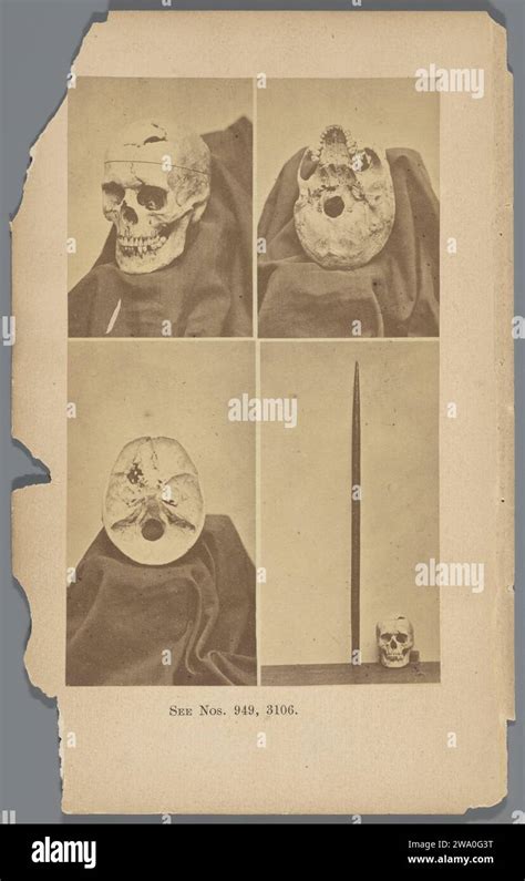 Four views of the skull of Phineas Gage, Anonymous, 1868 photograph ...