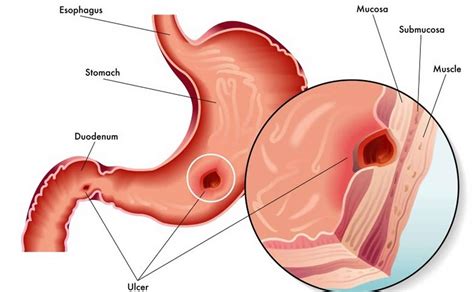 Curling ulcer causes, signs, symptoms, diagnosis, treatment & prognosis