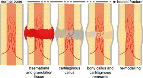 Stages of fracture healing - MedchromeTube