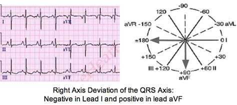 CARDIAC AXIS INTERPRETATION BASICS OF ECG, 59% OFF