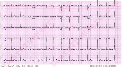 Sinus Arrhythmia ECG (Example 2) | Learn the Heart