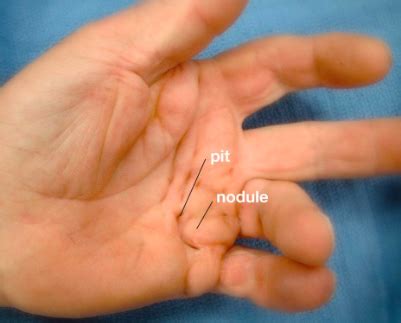 Dupuytren’s Contracture – Carolyn Yang, MD