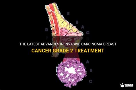 The Latest Advances In Invasive Carcinoma Breast Cancer Grade 2 ...