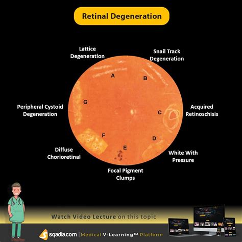 Retinal Degeneration | Retinal degeneration, Eye health facts, Medical ...