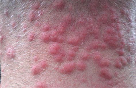 Brown Tail Moth Rash Pictures | Medical Pictures and Images - (2023 ...