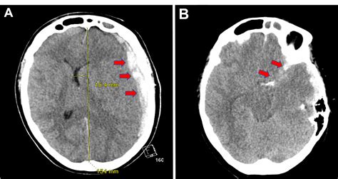 Cerebral Aneurysm Ct