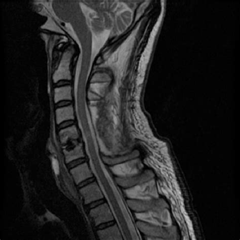 Cervical spine MRı one month after laminectomy demonstrated complete ...