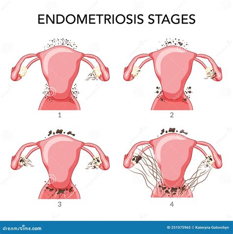 Endometriosis Stages Female Reproductive System Normal And With Disease ...