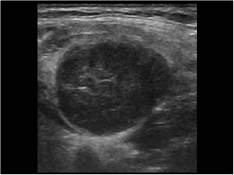 Head and Neck | 4.4 Lymph nodes : Case 4.4.2 Malignant lymph nodes ...