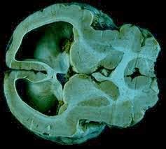 Medical Treatment Pictures-for Better Understanding: Lissencephaly