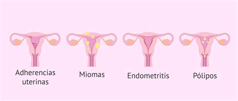 TIpos de tumoraciones y alteraciones endometriales