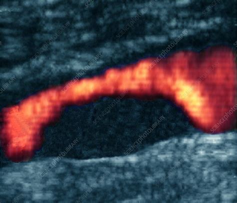 Atheroma plaque, Doppler ultrasound - Stock Image M175/0297 - Science ...