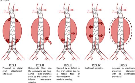 Figure 5 from Endovascular Aortic Aneurysm Repair (EVAR) | Semantic Scholar